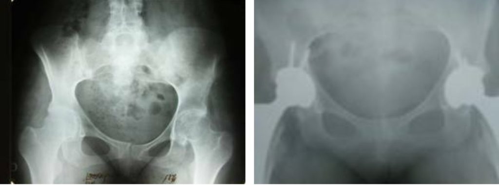 Рис. 3 - Рентгенограма кульшових суглобів до операції і після ендопротезування. (Діагноз: двосторонній кокс артроз IV ст.)
