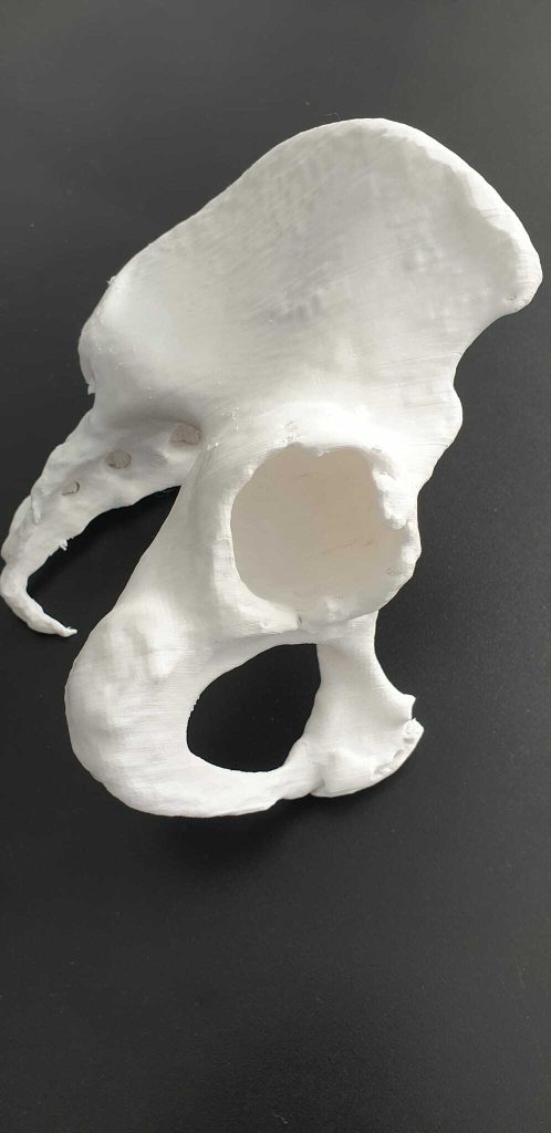 Рис.2 Виконано комп'ютерну томографію кульшового суглоба з виготовленням 3D моделі