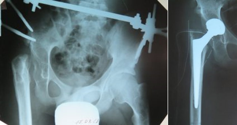 Рис.3. рентгенограма хворого І. на етапі опущення проксимального відділу стегна до анатомічного рівня кульшової западини; та рентгенограма кульшового суглоба після ендопротезування.