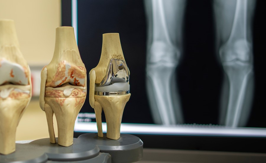 Остеоартроз (остоартрит) колінного суглоба. Коли ставити діагноз? Коли та як починати лікувати?