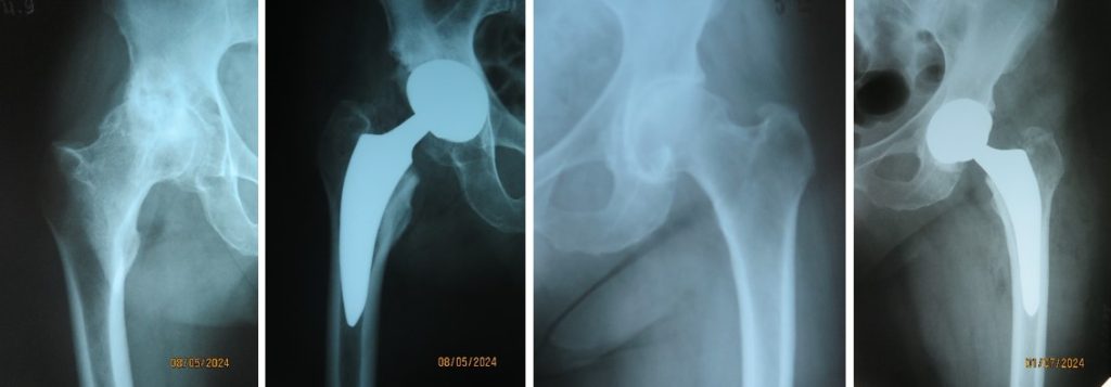 Заміна кульшового суглоба з доступом у зоні «бікіні» (Bikini Hip Replacement) - варіант переднього доступу з покращеним загоєнням ран, естетично прихований розріз