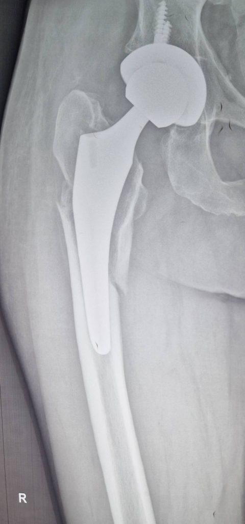 Ревізійне ендопротезування, при перипротезних переломах, особливо тип В2, потребує заміни ніжки протеза, як правило на ревізійну, і стабільного остеосинтеза відламків проксимального відділу стегнової кістки з заміщенням дефектів кістки трансплататом. Клінічний приклад ревізійного ендопротезування при перипротезному переломі стегнової кістки представлено на рентгенограмах.