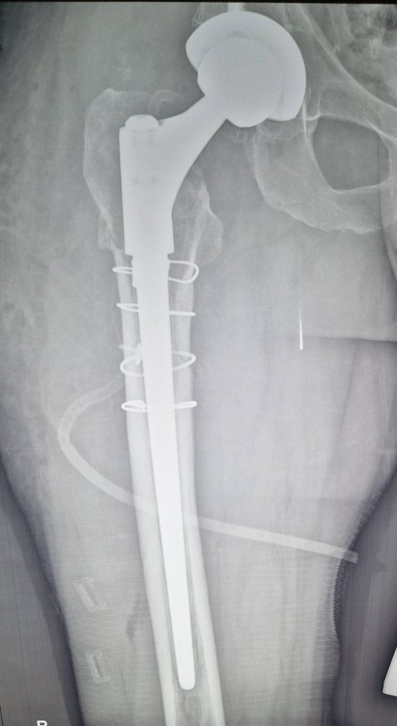 Ревізійне ендопротезування при перипротезних переломах